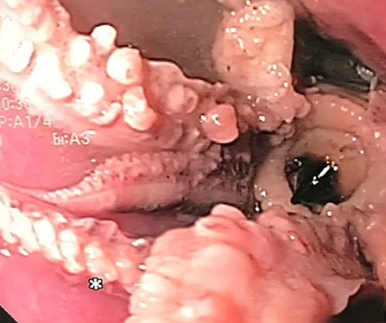 Descoperirea șocantă făcută de medici în esofagul unui pacient / Sursa foto: Clinical Gastroenterology and Hepatology